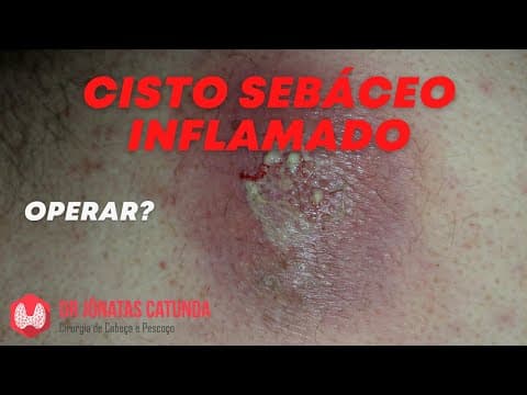 Cisto sebáceo - tratamento com cirurgia após desinflamar