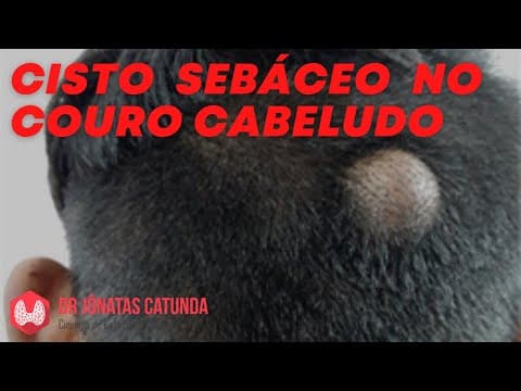 Cisto sebáceo no couro cabeludo: nasce cabelo depois?