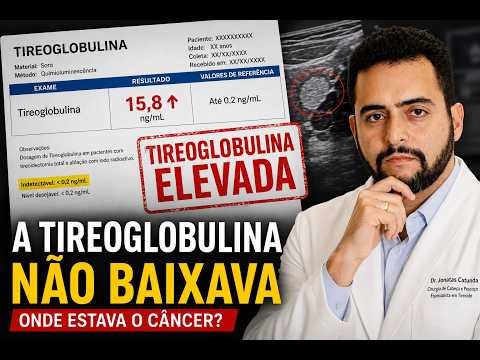 A tireoglobulina não baixava: encontramos a metástase escondida