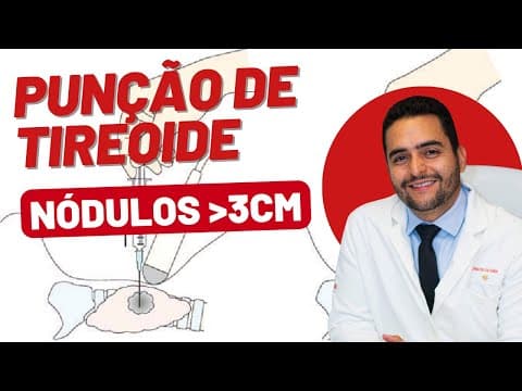Nódulo Grande na Tireoide: Punção não é confiável!
