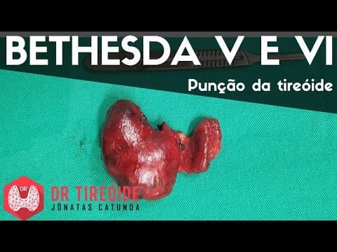 PAAF da tireóide Bethesda V e Bethesda VI - Carcinoma papilífero | Dr Jônatas Catunda