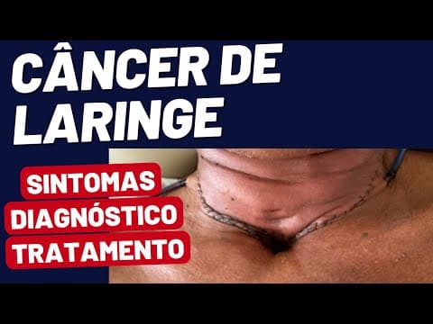 Câncer de Laringe: Como Reconhecer os Sintomas e Garantir o Tratamento Correto