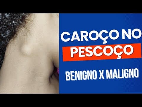 Caroço no pescoço: linfonodo benigno ou maligno?