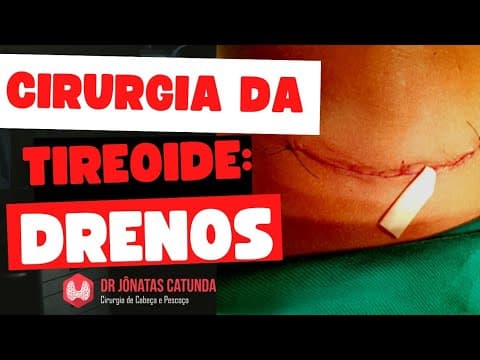 Pode ir pra casa com o dreno na cirurgia da tireoide? - Respondendo perguntas ao vivo