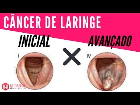Diferenças do câncer de laringe em estágio inicial e avançado - Dr Jônatas Catunda