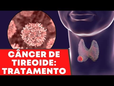 Etapas do tratamento do câncer de tireoide