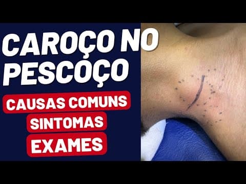 CAROÇO NO PESCOÇO: É GRAVE? Sintomas, Causas e Exames Explicados!