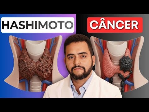 Tireoidite de Hashimoto e câncer de tireoide: qual é a relação?