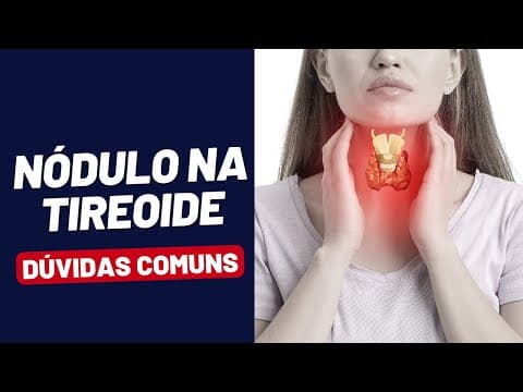 NODULO NA TIREOIDE - DÚVIDAS COMUNS