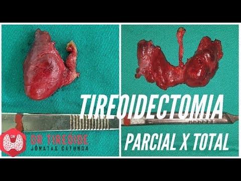 Tireoidectomia parcial ou Tireoidectomia total? | Dr Jônatas Catunda