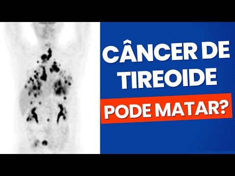 Câncer de tireoide pode matar? Entenda quais as chances!