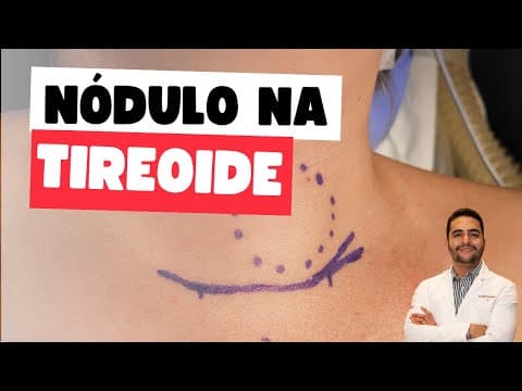 Nódulo na tireóide - 5 situações preocupantes