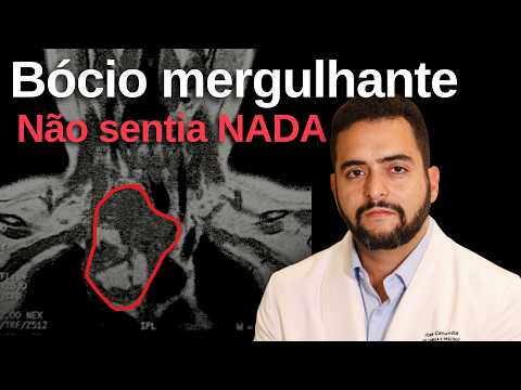 Bócio mergulhante: por que mesmo benigno e sem sintomas tem indicação de cirurgia