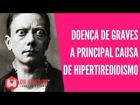 Doença de Graves, a causa mais comum de Hipertireoidismo | Dr Jônatas Catunda