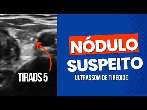 Nódulo na tireóide - características do câncer - classificação Tirads 5 no ultrassom de tireoide