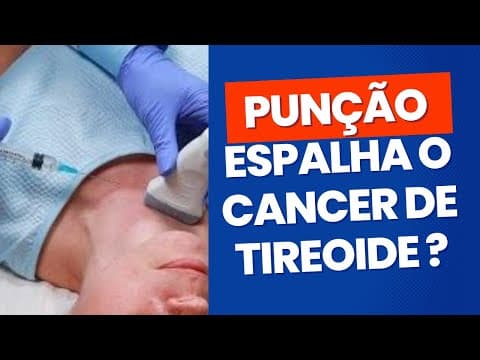 PAAF de nódulo na tireoide pode espalhar o câncer?