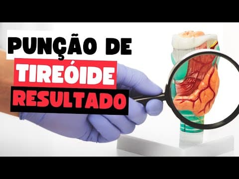 Resultados da PAAF de Tireoide: Como Interpretar? O que significa Bethesda?