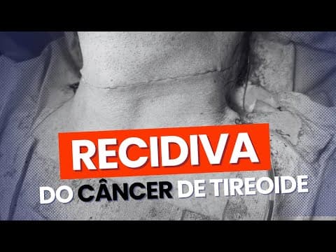 Tipos de Recidiva do Câncer de tireoide