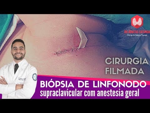Biopsia de linfonodo supraclavicular com anestesia geral - Cirurgia filmada