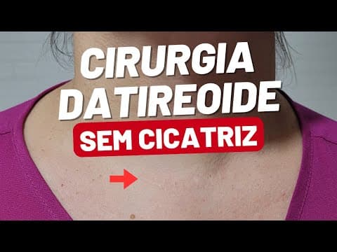 CIRUGIA ROBOTICA DA TIREOIDE EM 2025