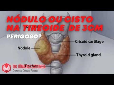 Nódulo ou cisto na tireoide de 3cm - é preocupante? Cirurgia? Medicamento?