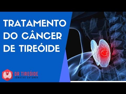 Tratamento do Câncer de Tireóide - Dr Tireóide responde