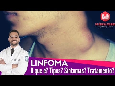 O que é Linfoma? Tipos de linfoma, Sintomas, Tratamento - Dr Jônatas Catunda