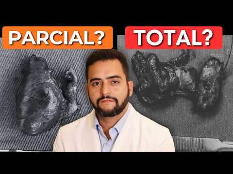 Cirurgia parcial ou total da tireoide? Como decidir no nódulo suspeito