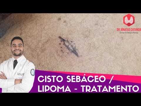Cisto sebáceo / Lipoma: tratamento