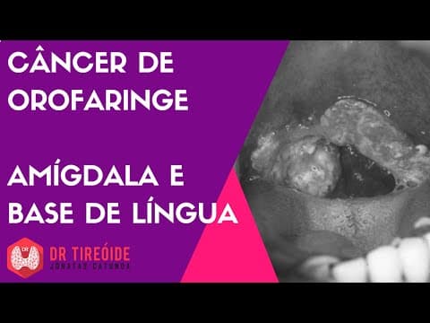 Câncer de orofaringe - garganta, amígdala, base de língua