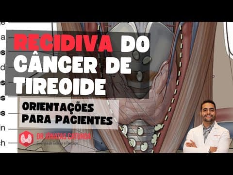 Recidiva do câncer de tireoide - orientações para pacientes