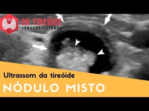 Nódulo misto na tireóide | Dr Jônatas Catunda