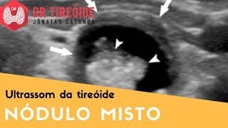 Nódulo misto na tireóide | Dr Jônatas Catunda