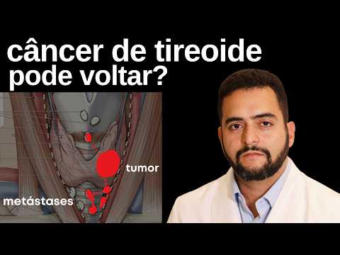 O Câncer de Tireoide Voltou — ou Nunca Foi Embora? Recidiva vs Persistência