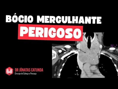 Bócio mergulhante perigoso / Câncer de seio piriforme / Nódulo na tireoide que regrediu
