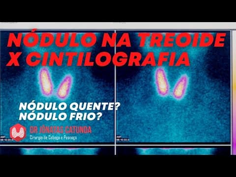 Cintilografia da tireoide - nódulos quentes e frios, qual a relação com o câncer?