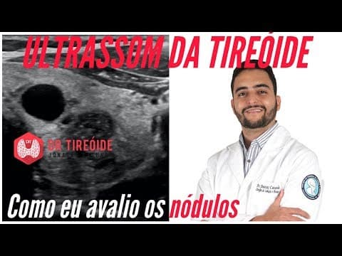 Ultrassom da tireóide - Como eu avalio os nódulos! | Dr Jônatas Catunda