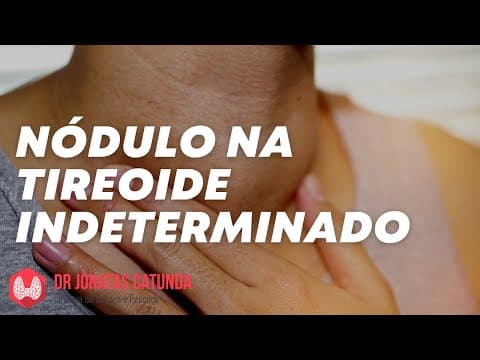 Nódulo na tireóide grande e indeterminado