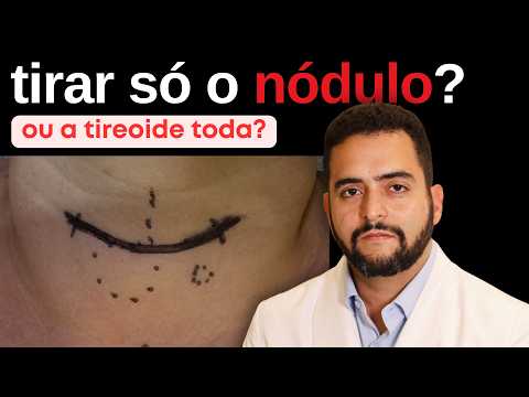 Câncer de Tireoide: dá para tirar só o nódulo?