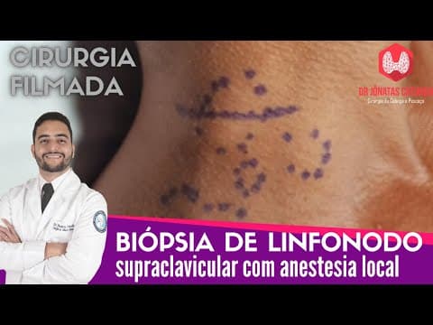 Biopsia de linfonodo supraclavicular com anestesia local - Cirurgia completa
