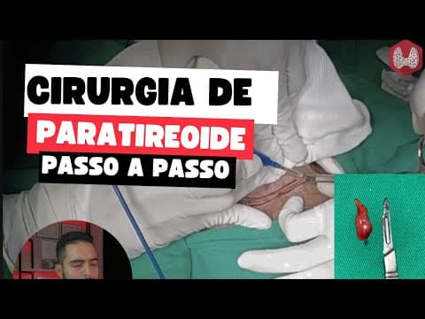 Cirurgia de paratireoide passo a passo: tratando o hiperparatireoidismo