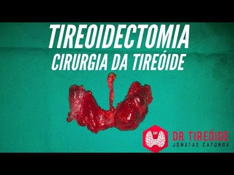 O que você precisa saber sobre a tireoidectomia, a cirurgia da tireóide! | Dr Jônatas Catunda