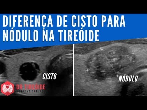 Diferença de cisto para nódulo de tireóide | Dr Tireóide Responde