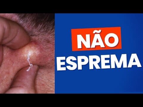 Cisto sebáceo (cisto de massa) - não esprema! Tratamento
