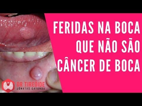 Feridas ou lesões na boca que NÃO são câncer de boca | Dr Jônatas Catunda