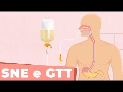 Sonda nasoenteral X Gastrostomia - Câncer de cabeça e pescoço