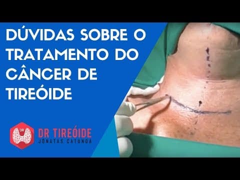 Dúvidas sobre o tratamento do câncer de tireóide | Dr Tireóide Responde