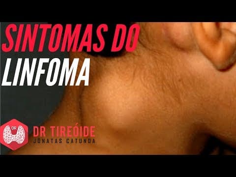 Linfoma: Entenda os sintomas! | Dr Jônatas Catunda
