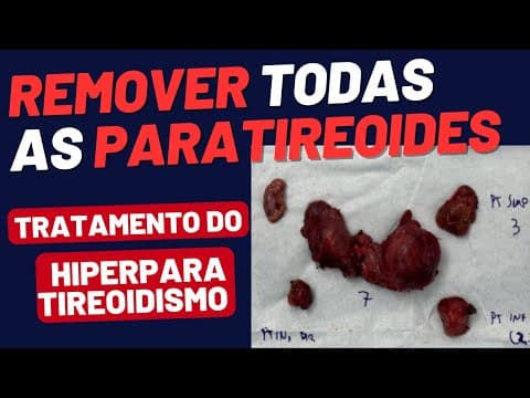 Retirada Total da Tireoide e das 4 Paratireoides: Como Fica a Saúde Depois da Cirurgia?