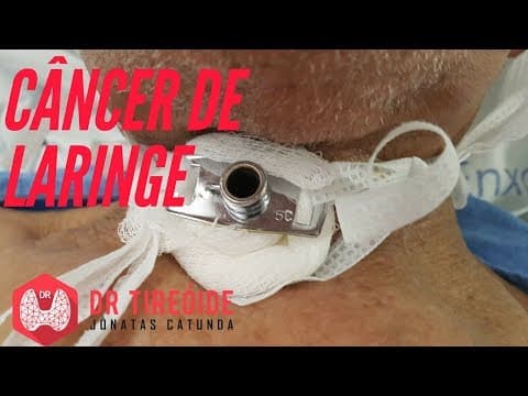 Câncer de laringe - Sintomas, diagnóstico e tratamento! | Dr Jônatas Catunda